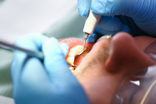 Best Emergency Wisdom Teeth Removal in Lincoln Village, CA