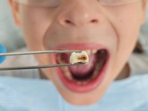 Best Emergency Wisdom Teeth Removal in Lincoln Village, CA